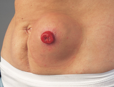 Hernia